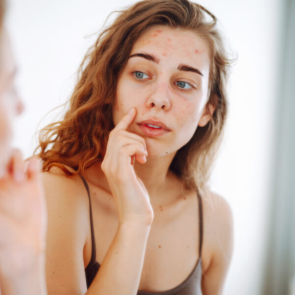 Млада жена със СПКЯ гледа лицето си, склонно към акне, в огледалото – Катафертил