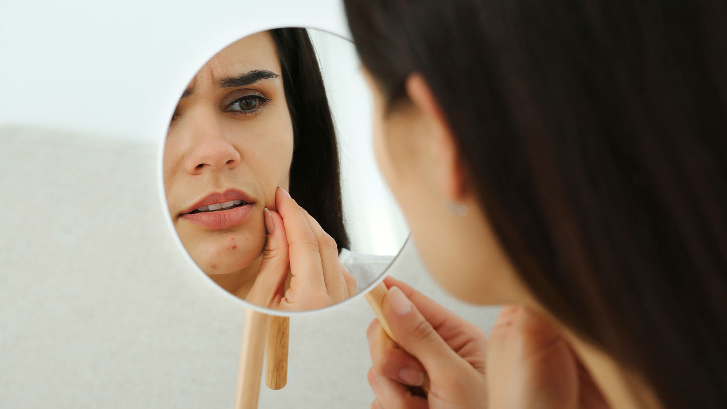 Catafertyl-акне-в-огледалото