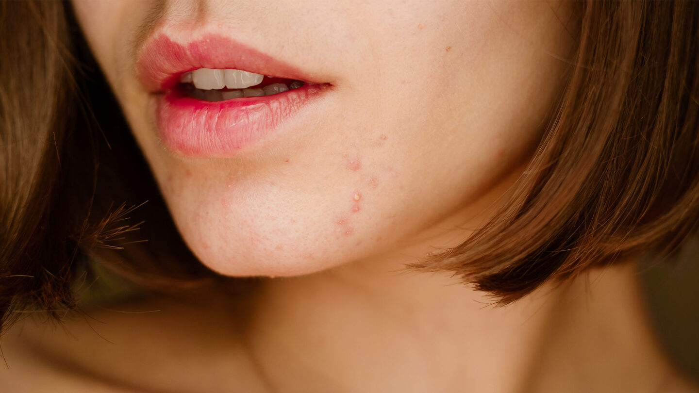 Жена със СПКЯ и акне по лицето – Катафертил